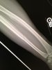 brokenarm.jpg