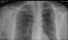 chest and clavical1.jpg